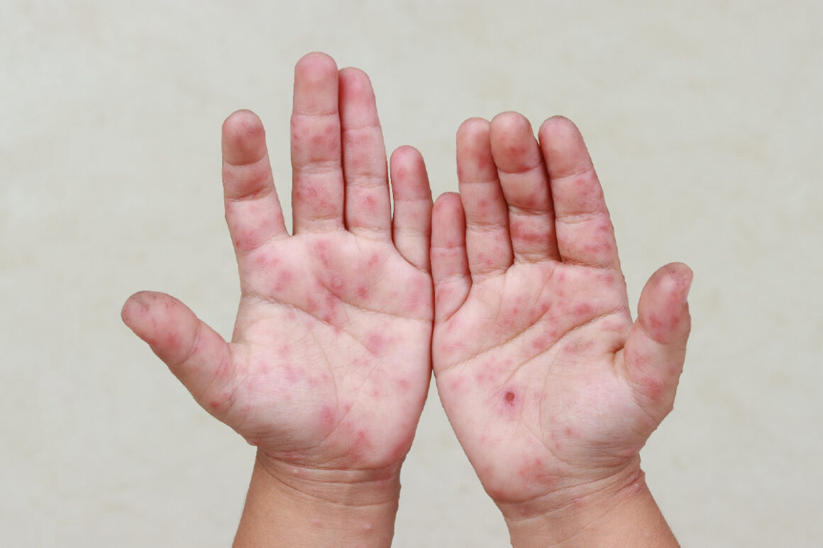 Deputada propõe política estadual para prevenir surtos da síndrome mão-pé-boca nas escolas do Maranhão