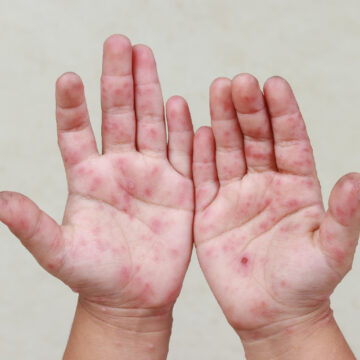 Deputada propõe política estadual para prevenir surtos da síndrome mão-pé-boca nas escolas do Maranhão